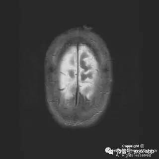 【病例】硬脑膜浆细胞瘤1例MR影像表现 【病例】硬脑膜浆细胞瘤1例MR影像表现