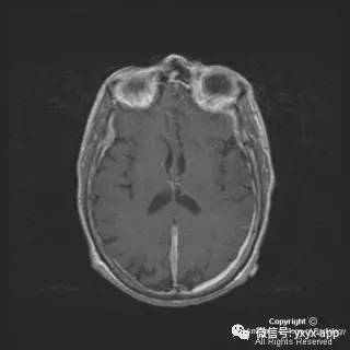 【病例】硬脑膜浆细胞瘤1例MR影像表现 【病例】硬脑膜浆细胞瘤1例MR影像表现