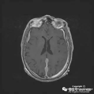 【病例】硬脑膜浆细胞瘤1例MR影像表现 【病例】硬脑膜浆细胞瘤1例MR影像表现