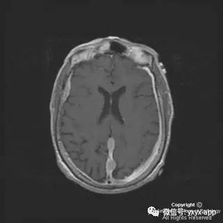 【病例】硬脑膜浆细胞瘤1例MR影像表现 【病例】硬脑膜浆细胞瘤1例MR影像表现