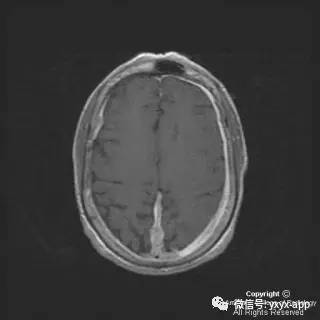 【病例】硬脑膜浆细胞瘤1例MR影像表现 【病例】硬脑膜浆细胞瘤1例MR影像表现
