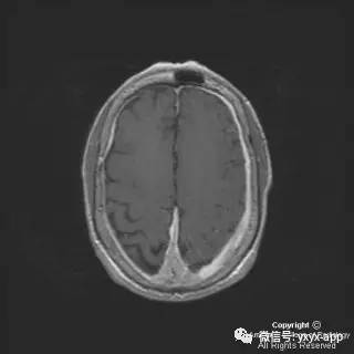 【病例】硬脑膜浆细胞瘤1例MR影像表现 【病例】硬脑膜浆细胞瘤1例MR影像表现
