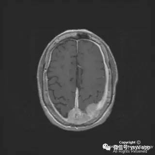 【病例】硬脑膜浆细胞瘤1例MR影像表现 【病例】硬脑膜浆细胞瘤1例MR影像表现