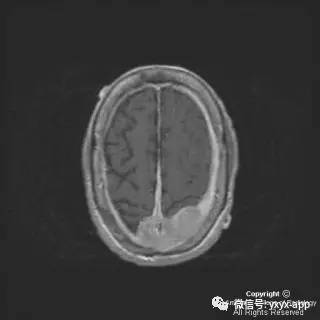 【病例】硬脑膜浆细胞瘤1例MR影像表现 【病例】硬脑膜浆细胞瘤1例MR影像表现