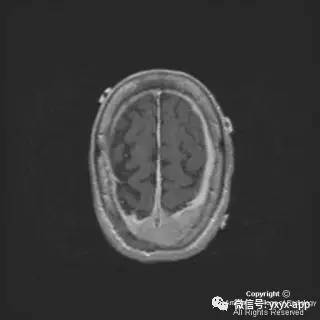 【病例】硬脑膜浆细胞瘤1例MR影像表现 【病例】硬脑膜浆细胞瘤1例MR影像表现