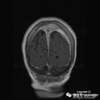 【病例】硬脑膜浆细胞瘤1例MR影像表现 【病例】硬脑膜浆细胞瘤1例MR影像表现