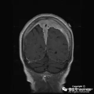 【病例】硬脑膜浆细胞瘤1例MR影像表现 【病例】硬脑膜浆细胞瘤1例MR影像表现
