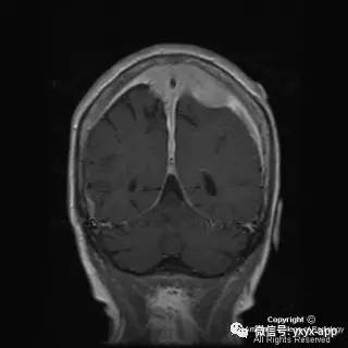 【病例】硬脑膜浆细胞瘤1例MR影像表现 【病例】硬脑膜浆细胞瘤1例MR影像表现