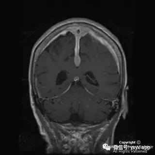 【病例】硬脑膜浆细胞瘤1例MR影像表现 【病例】硬脑膜浆细胞瘤1例MR影像表现