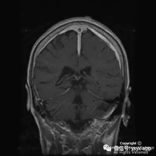 【病例】硬脑膜浆细胞瘤1例MR影像表现 【病例】硬脑膜浆细胞瘤1例MR影像表现