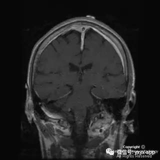 【病例】硬脑膜浆细胞瘤1例MR影像表现 【病例】硬脑膜浆细胞瘤1例MR影像表现