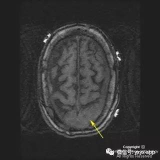 【病例】硬脑膜浆细胞瘤1例MR影像表现 【病例】硬脑膜浆细胞瘤1例MR影像表现