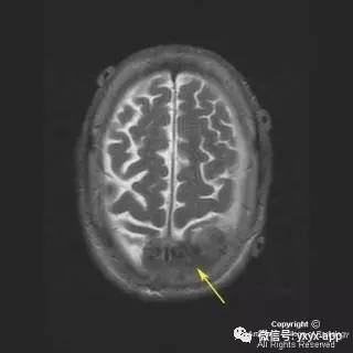 【病例】硬脑膜浆细胞瘤1例MR影像表现 【病例】硬脑膜浆细胞瘤1例MR影像表现