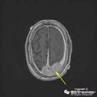 【病例】硬脑膜浆细胞瘤1例MR影像表现