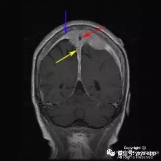 【病例】硬脑膜浆细胞瘤1例MR影像表现 【病例】硬脑膜浆细胞瘤1例MR影像表现