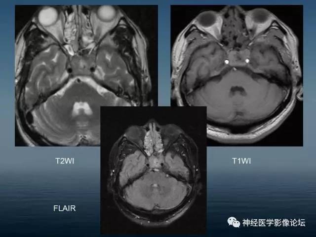 【病例】颅底浆细胞瘤1例CT及MR 【病例】颅底浆细胞瘤1例CT及MR