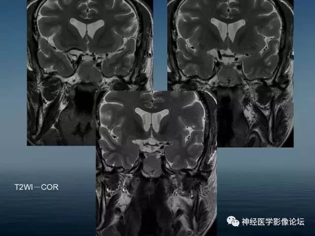 【病例】颅底浆细胞瘤1例CT及MR 【病例】颅底浆细胞瘤1例CT及MR