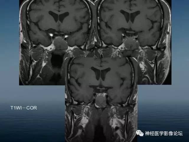 【病例】颅底浆细胞瘤1例CT及MR 【病例】颅底浆细胞瘤1例CT及MR