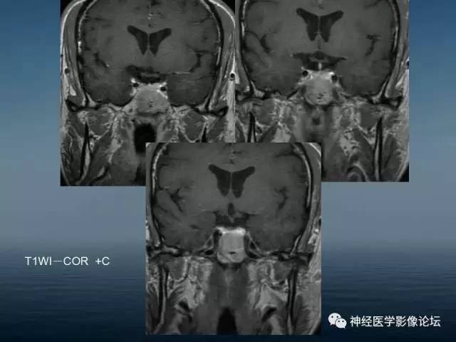 【病例】颅底浆细胞瘤1例CT及MR 【病例】颅底浆细胞瘤1例CT及MR