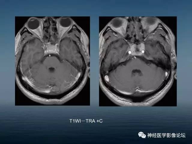 【病例】颅底浆细胞瘤1例CT及MR 【病例】颅底浆细胞瘤1例CT及MR