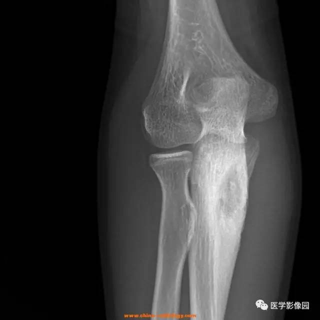 【病例】骨样骨瘤1例X线CT影像表现