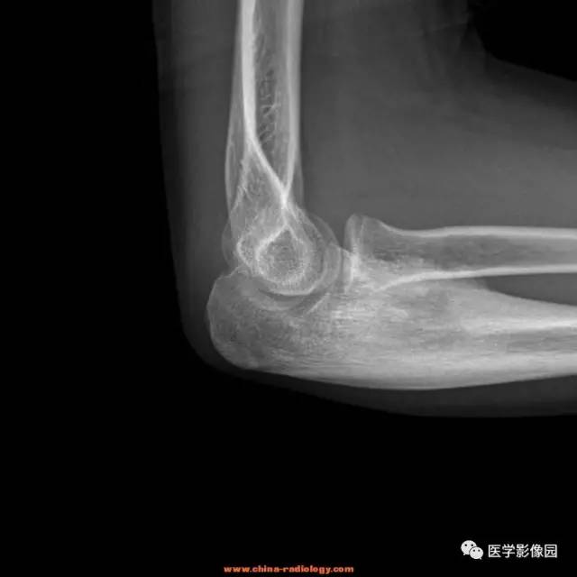 【病例】骨样骨瘤1例X线CT影像表现