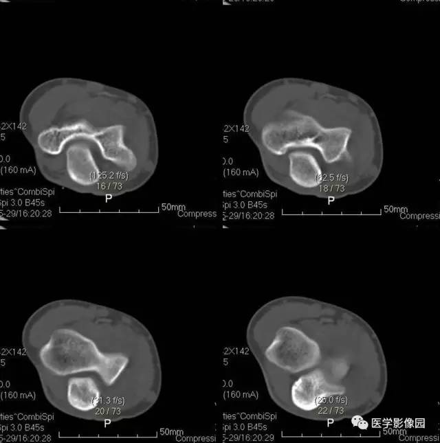 【病例】骨样骨瘤1例X线CT影像表现