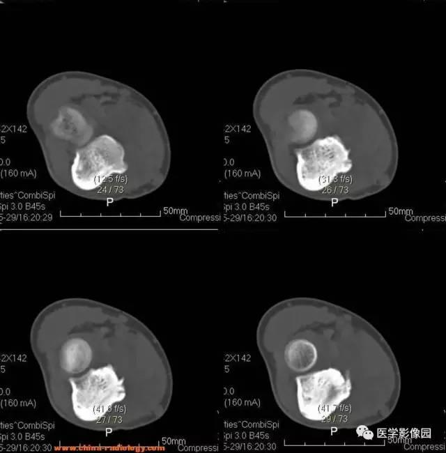 【病例】骨样骨瘤1例X线CT影像表现