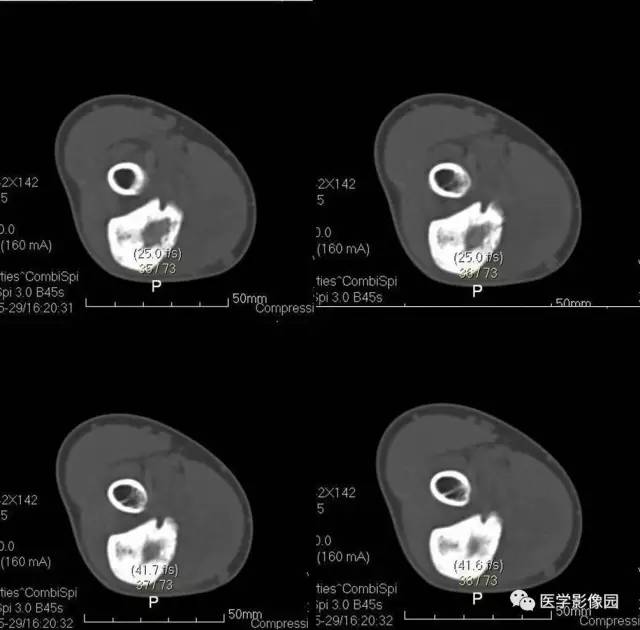 【病例】骨样骨瘤1例X线CT影像表现