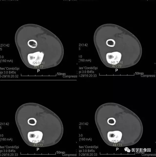 【病例】骨样骨瘤1例X线CT影像表现