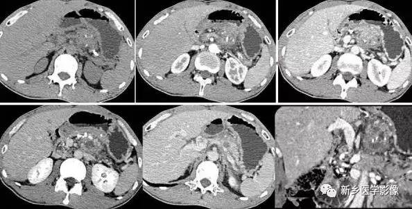 5种胰腺炎性病变 5种胰腺炎性病变
