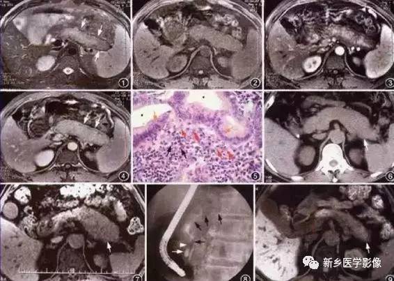 5种胰腺炎性病变 5种胰腺炎性病变