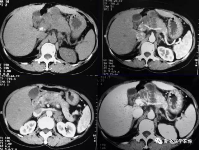 5种胰腺炎性病变 5种胰腺炎性病变