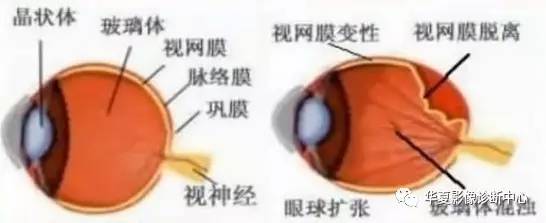 视网膜脱离和脉络膜脱离 【病例】溶血性尿毒综合征1例CT及MR影像表现