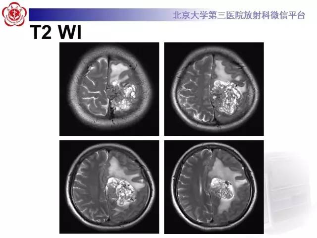 【病例】血管外皮细胞瘤/血管周细胞瘤1例MR