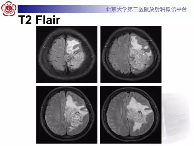 【病例】血管外皮细胞瘤/血管周细胞瘤1例MR