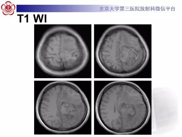 【病例】血管外皮细胞瘤/血管周细胞瘤1例MR