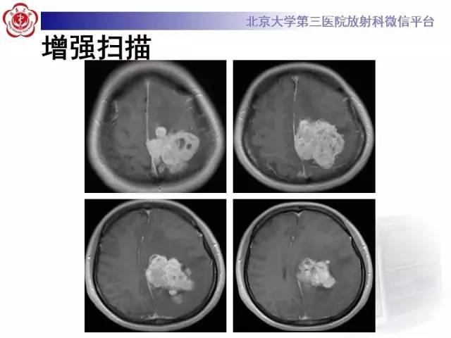 【病例】血管外皮细胞瘤/血管周细胞瘤1例MR