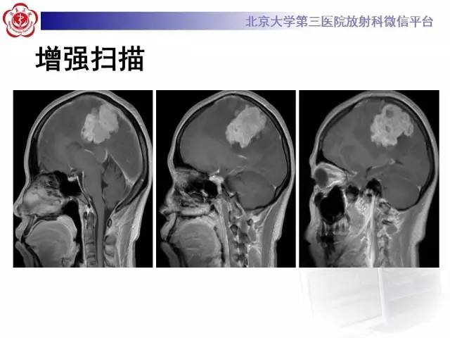 【病例】血管外皮细胞瘤/血管周细胞瘤1例MR