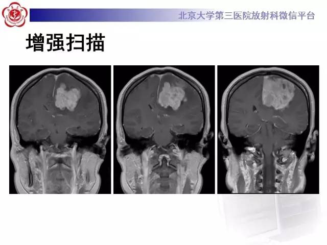 【病例】血管外皮细胞瘤/血管周细胞瘤1例MR