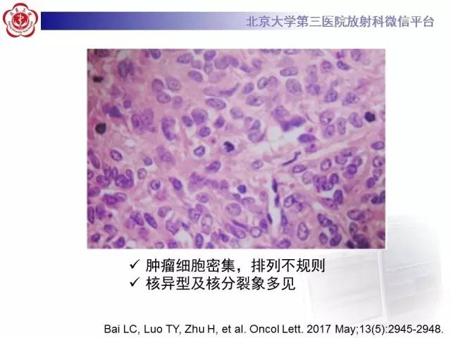 【病例】血管外皮细胞瘤/血管周细胞瘤1例MR