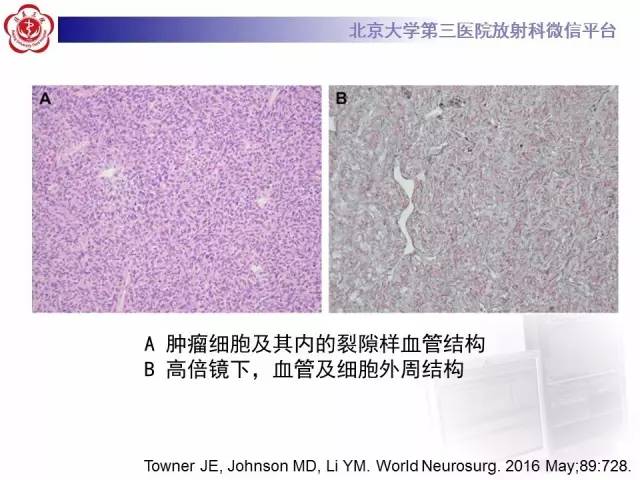 【病例】血管外皮细胞瘤/血管周细胞瘤1例MR