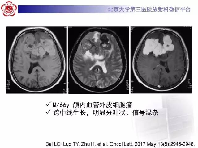 【病例】血管外皮细胞瘤/血管周细胞瘤1例MR