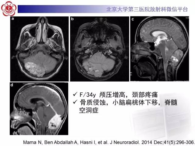 【病例】血管外皮细胞瘤/血管周细胞瘤1例MR