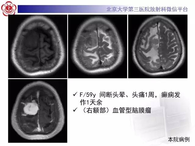 【病例】血管外皮细胞瘤/血管周细胞瘤1例MR
