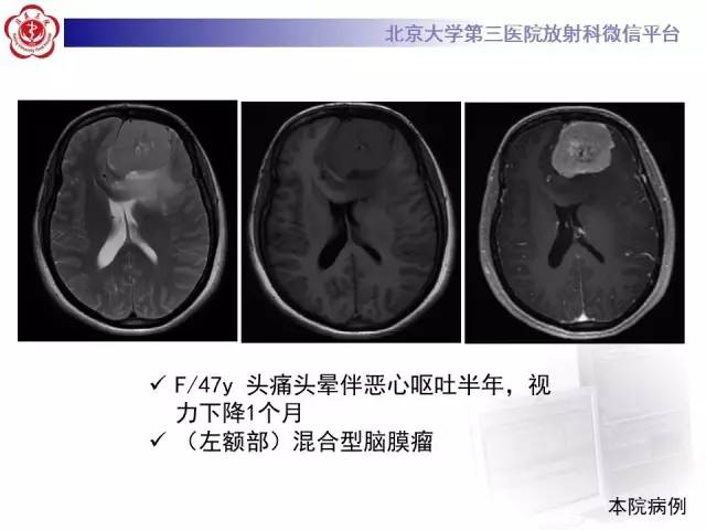 【病例】血管外皮细胞瘤/血管周细胞瘤1例MR