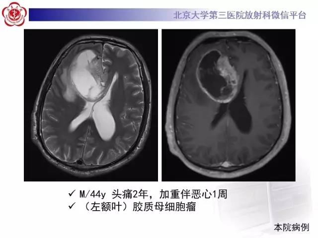 【病例】血管外皮细胞瘤/血管周细胞瘤1例MR