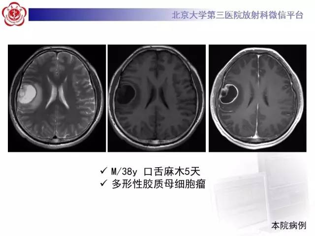 【病例】血管外皮细胞瘤/血管周细胞瘤1例MR