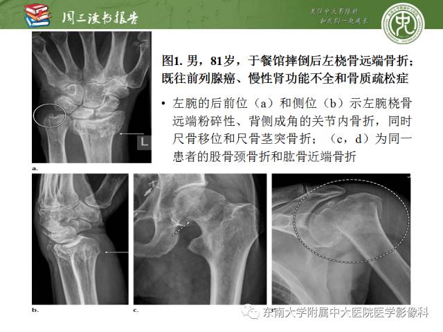 【PPT】代谢性骨病影像学表现【RG精选】