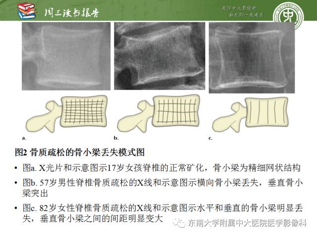 【PPT】代谢性骨病影像学表现【RG精选】